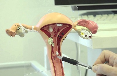 Конизация шейки матки в Израиле
